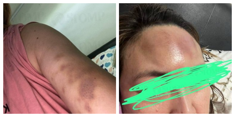 maid_attacked_by_employer_in_singapore